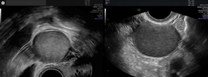 Can Endometriomas shrink?