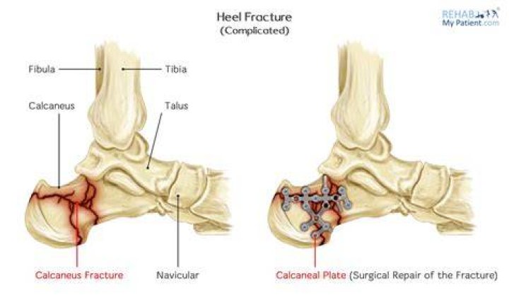 Can you break your heel?